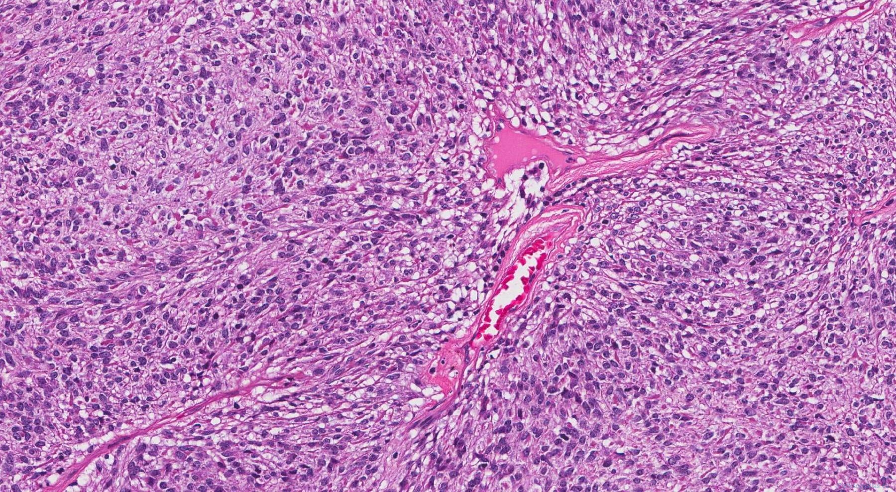 Gastrointestinal stromal tumour of the esophagus | Atlas of Pathology