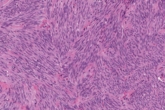 Gastrointestinal stromal tumour of the stomach