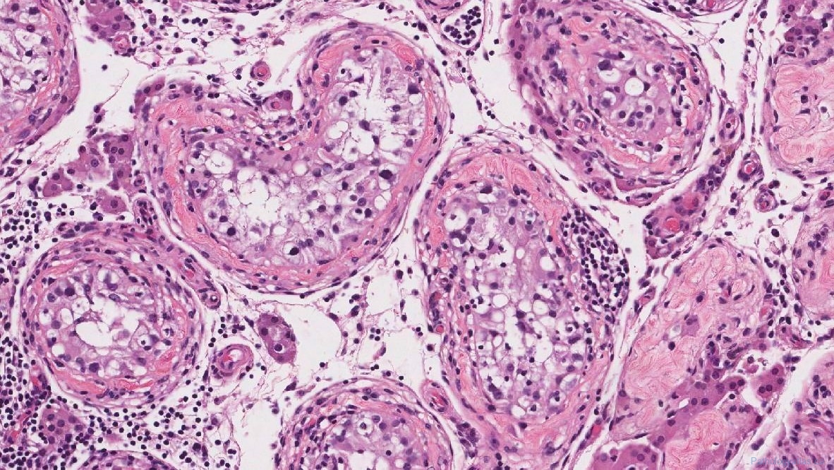 Germ Cell Neoplasia In Situ Of The Testis Atlas Of Pathology 