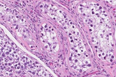 Germ cell neoplasia in situ of the testis