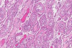 Germ cell neoplasia in situ of the testis