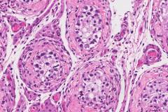 Germ cell neoplasia in situ of the testis