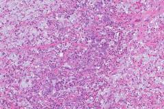 Goblet cell adenocarcinoma of the appendix