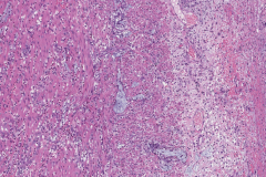 Goblet cell adenocarcinoma of the appendix