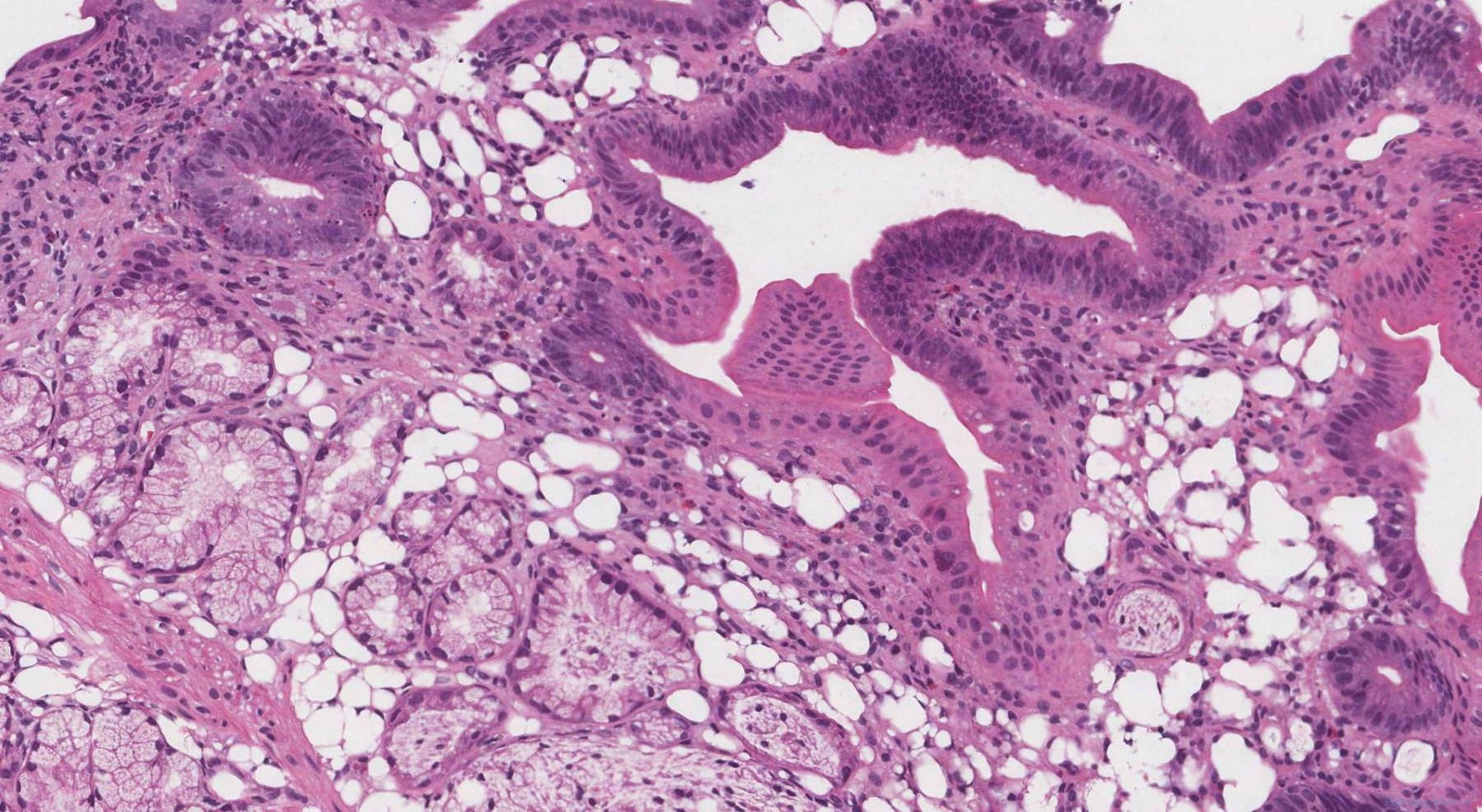 Graft Versus Host Disease Archives Atlas Of Pathology