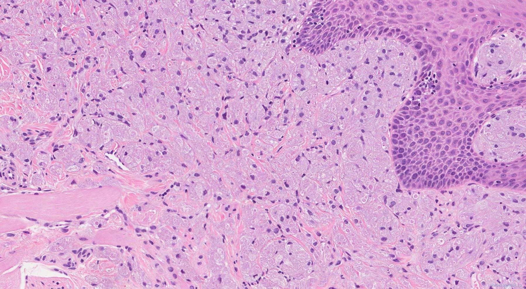 Granular Cell Tumour Atlas Of Pathology