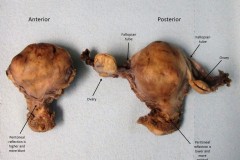 Gross orientation of the uterus and ovary