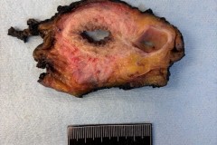 Urothelial carcinoma arising in a bladder diverticulum