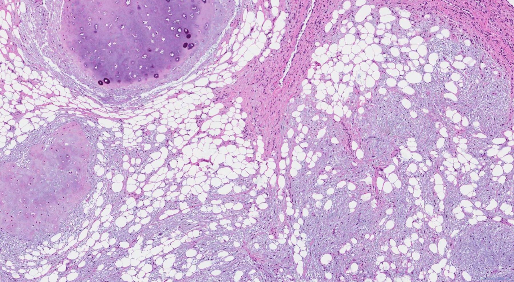 Hamartoma of the lung | Atlas of Pathology