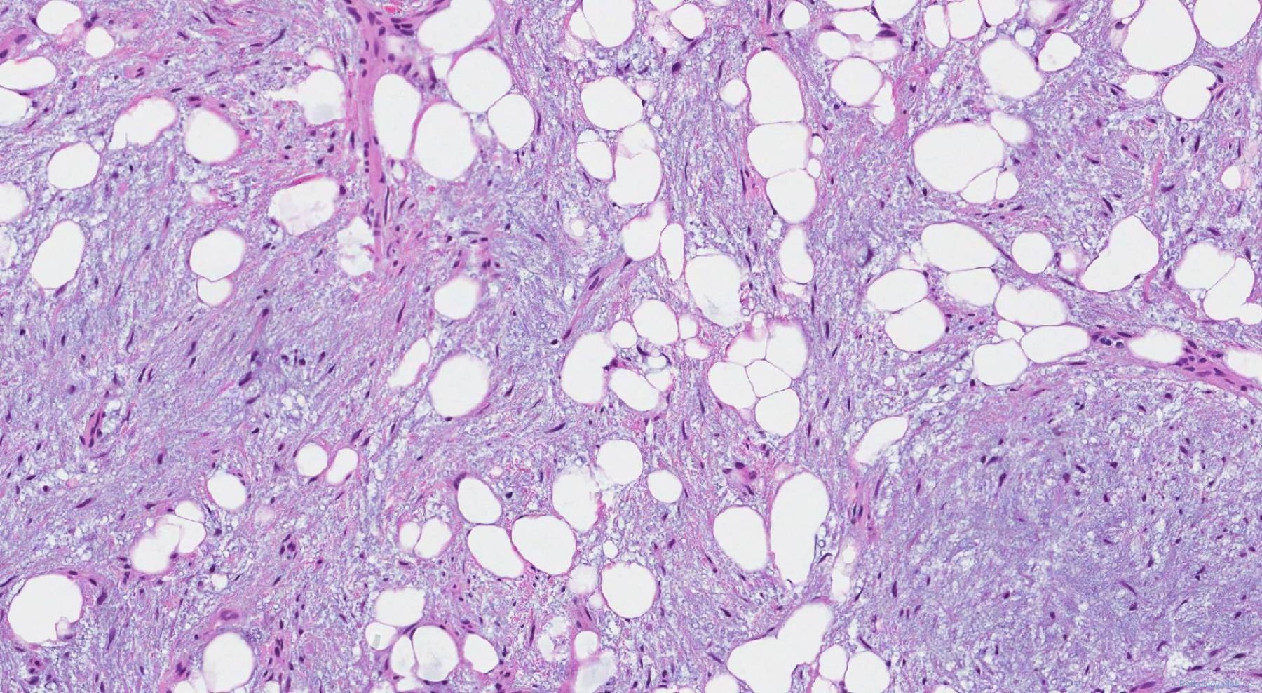 Hamartoma of the lung | Atlas of Pathology