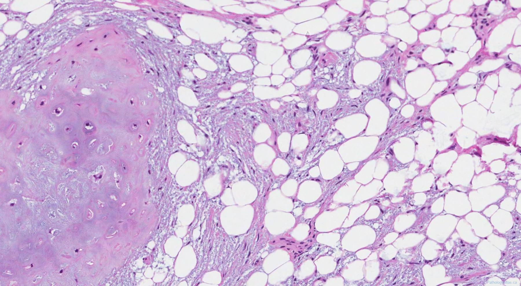 Hamartoma of the lung | Atlas of Pathology