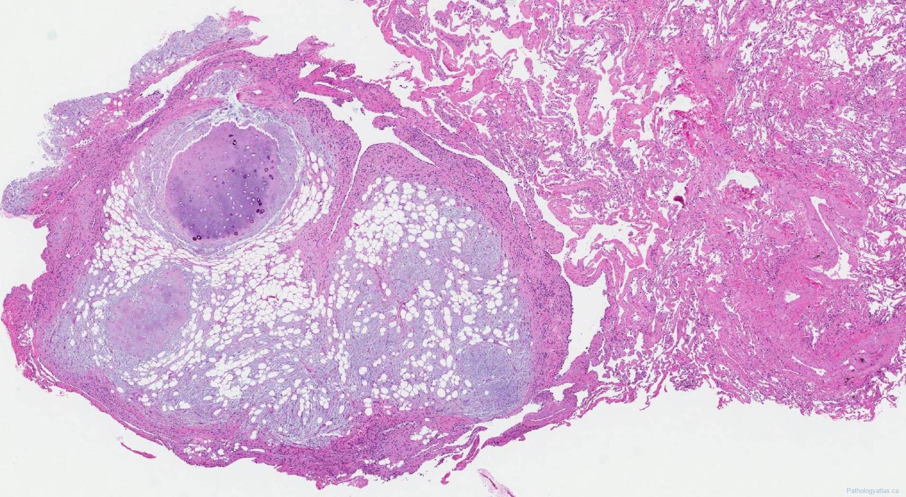 Hamartoma of the lung | Atlas of Pathology