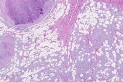 Hamartoma of the lung