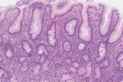 Helicobacter pylori associated chronic active gastritis