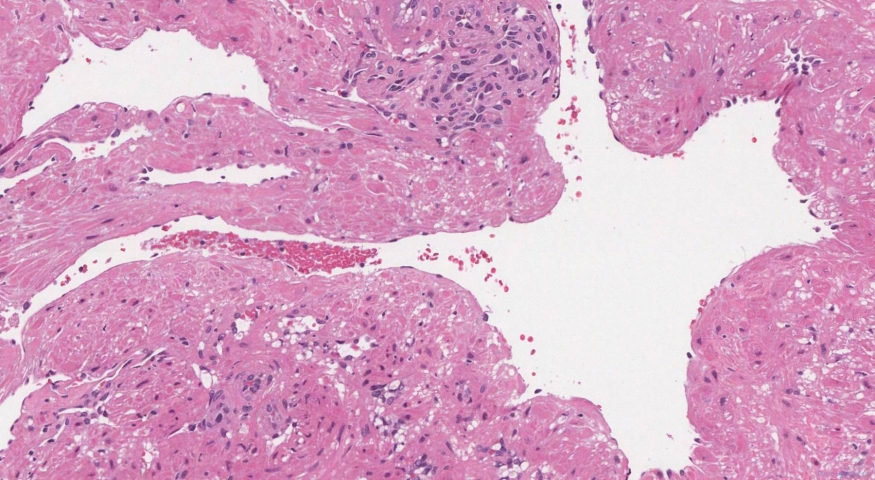 Venous hemangioma in the nasal cavity