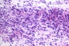 Lymphoma