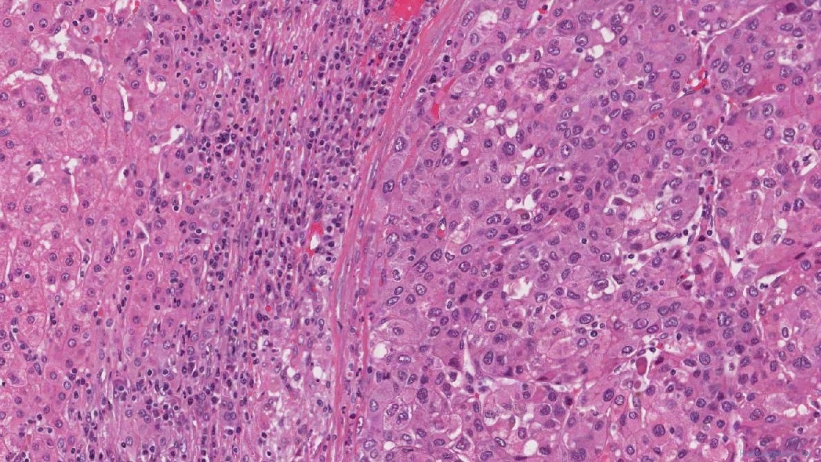 Hepatocellular carcinoma | Atlas of Pathology