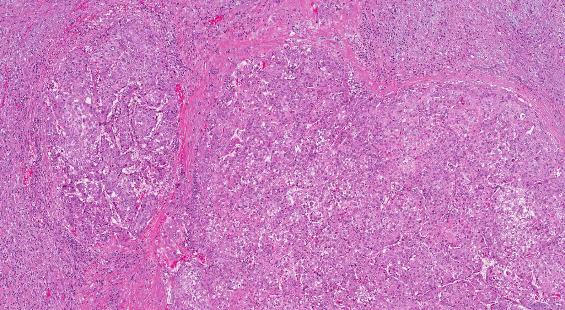 Hepatocellular carcinoma | Atlas of Pathology