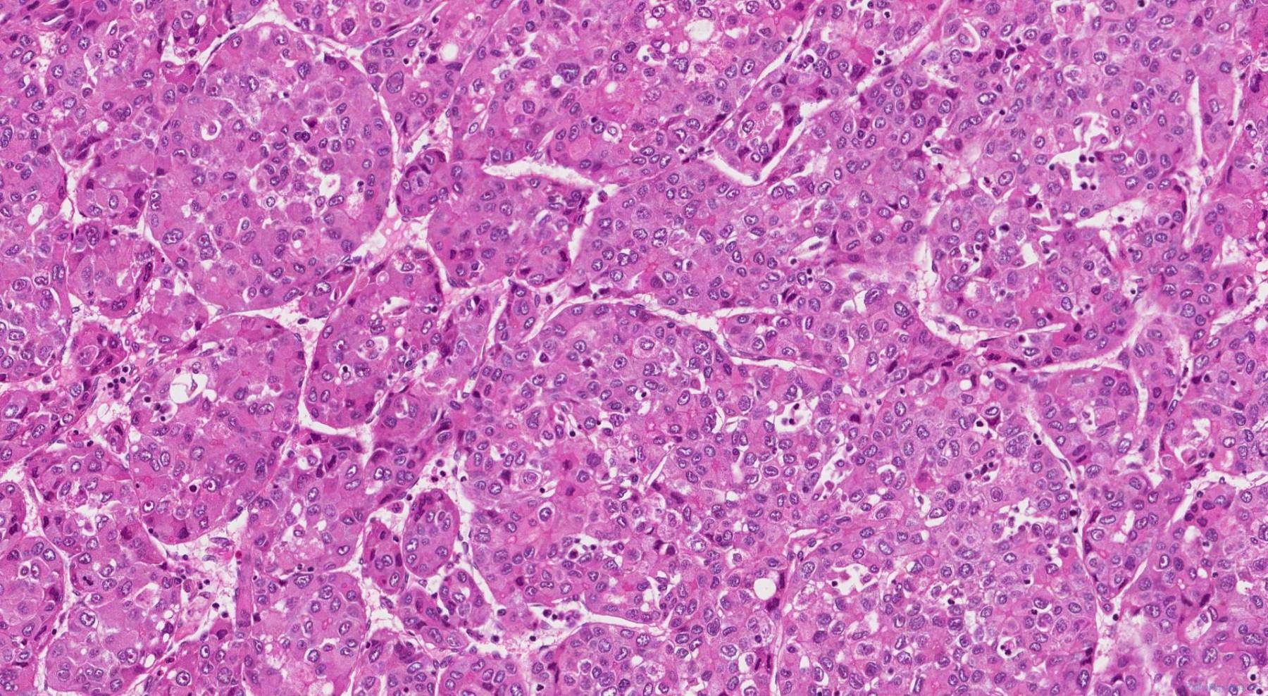 Hepatocellular Carcinoma Atlas Of Pathology