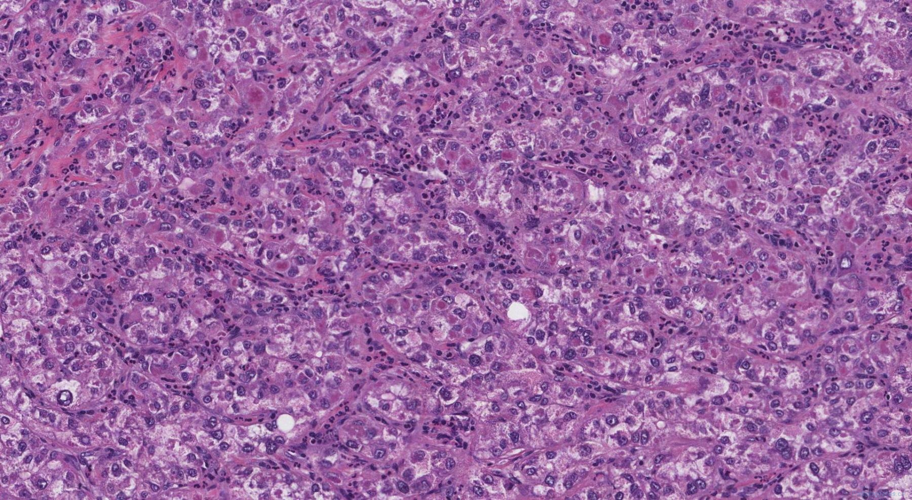 Hepatocellular carcinoma | Atlas of Pathology