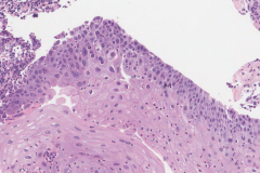 Herpes simplex virus infection of the esophagus