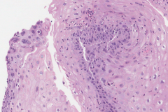 Herpes simplex virus infection of the esophagus