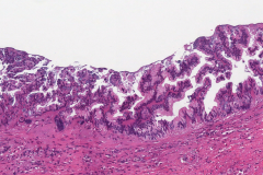 High grade appendiceal mucinous neoplasm