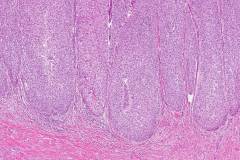 High grade papillary urothelial carcinoma with an inverted pattern of growth