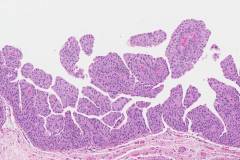 High grade papillary urothelial carcinoma