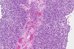 High grade papillary urothelial carcinoma