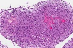 High grade papillary urothelial carcinoma