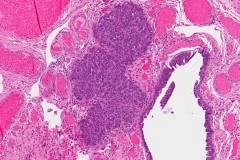 High grade serous carcinoma arising from a background of serous tubal intraepithelial carcinoma