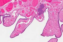 High grade serous carcinoma arising from a background of serous tubal intraepithelial carcinoma