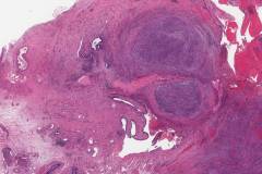 High grade serous carcinoma of the fallopian tube