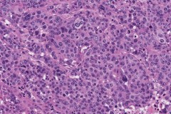 High grade serous carcinoma of the ovary