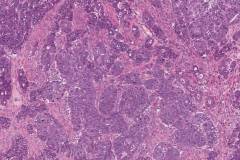 High grade serous carcinoma of the ovary