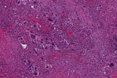 High grade serous carcinoma of the ovary