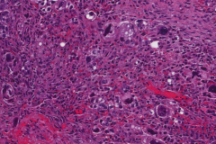 High grade serous carcinoma of the ovary