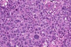 High grade serous carcinoma of the ovary