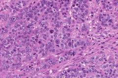 High grade serous carcinoma of the ovary