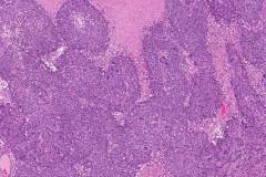 High grade serous carcinoma of the ovary