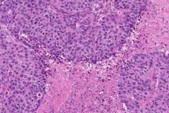 High grade serous carcinoma of the ovary