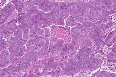 High grade serous carcinoma of the ovary