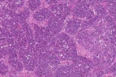 High grade serous carcinoma of the ovary