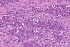 High grade serous carcinoma of the ovary