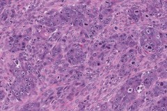 High grade serous carcinoma of the ovary