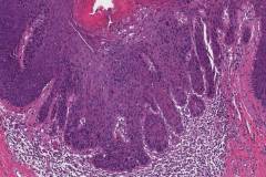 High grade squamous intraepithelial lesion of the perianal skin