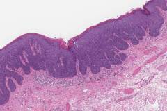 High grade squamous intraepithelial lesion of the perianal skin