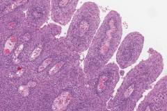 High grade squamous intraepithelial lesion of the anal canal