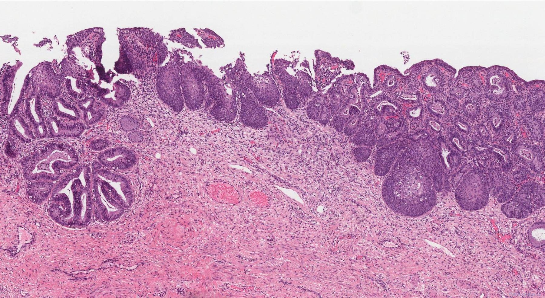 High Grade Squamous Intraepithelial Lesion Archives Atlas Of Pathology